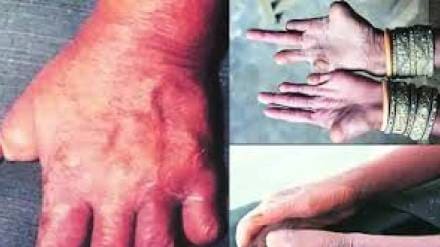 leprosy eradication