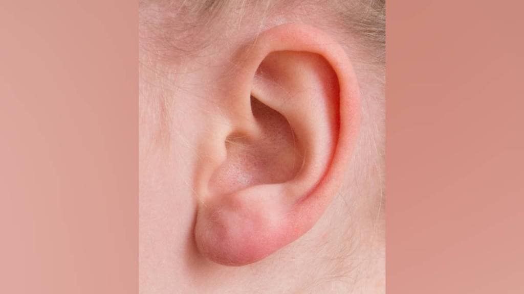 ear pain in monsoon, ear infection treatment Pune, monsoon ear care tips, ENT specialist Pune, ear infection symptoms, how to prevent ear infection, ear dryness after bath, ear infection home remedies, ear pain causes monsoon,