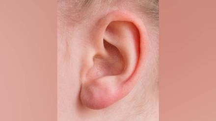 ear pain in monsoon, ear infection treatment Pune, monsoon ear care tips, ENT specialist Pune, ear infection symptoms, how to prevent ear infection, ear dryness after bath, ear infection home remedies, ear pain causes monsoon,