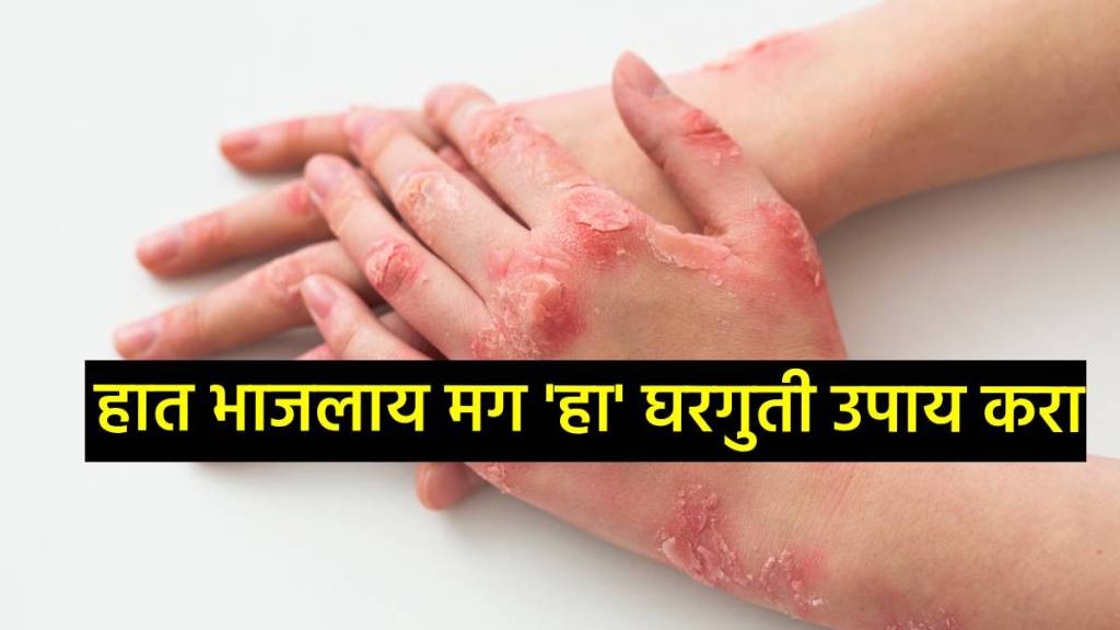 How to heal a burn fast at home