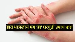 स्वयंपाक करताना हात भाजलाय? ‘हा’ घरगुती उपाय वापरा, जखम बरी होईलच पण डागही राहणार नाही