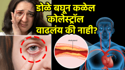 कोलेस्ट्रॉल वाढल्यावर डोळ्यांमध्ये दिसतात ‘ही’ ५ लक्षणे, दुर्लक्ष केलं तर येऊ शकतो हार्ट अटॅक; डॉक्टरांनी दिली महत्त्वाची माहिती