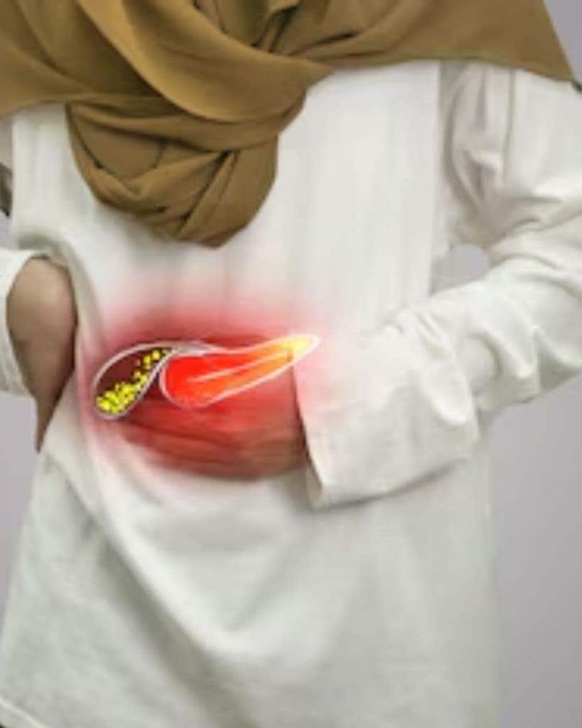 gallbladder stone