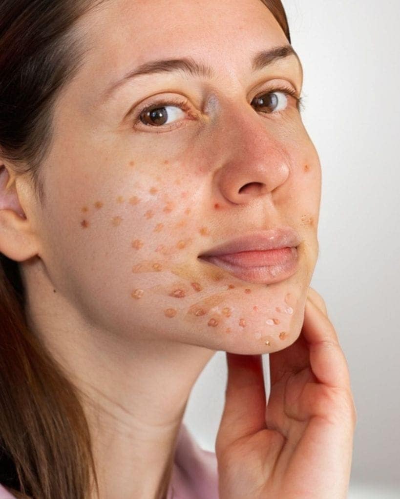 Using ice to remove acne | ice benefits for skin acne