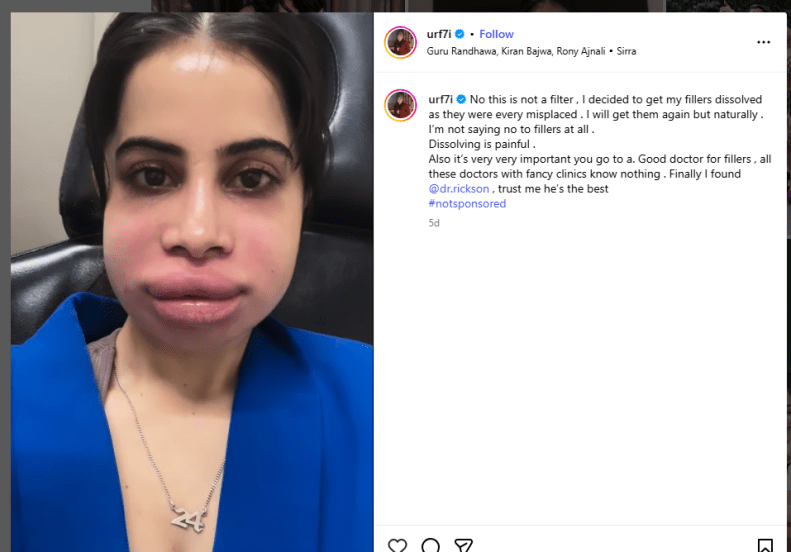 Urfi Javed Dissolves Lip Filler instagram post