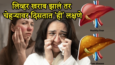 लिव्हर खराब असेल तर चेहऱ्यावर दिसतात ही ५ लक्षणे, लगेच सावध व्हा! डॉक्टरांचा सल्ला वाचाच