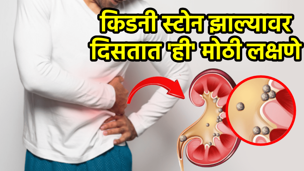 kidney stone symptoms first signs of kidney stones removal treatment causes