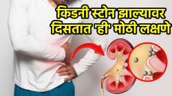 किडनी स्टोन झालाय की नाही हे लगेच ओळखा! सुरुवातीला दिसतात ‘ही’ मोठी लक्षणे, अजिबात दुर्लक्ष करु नका