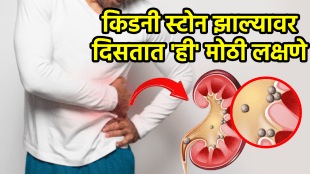 kidney stone symptoms first signs of kidney stones removal treatment causes