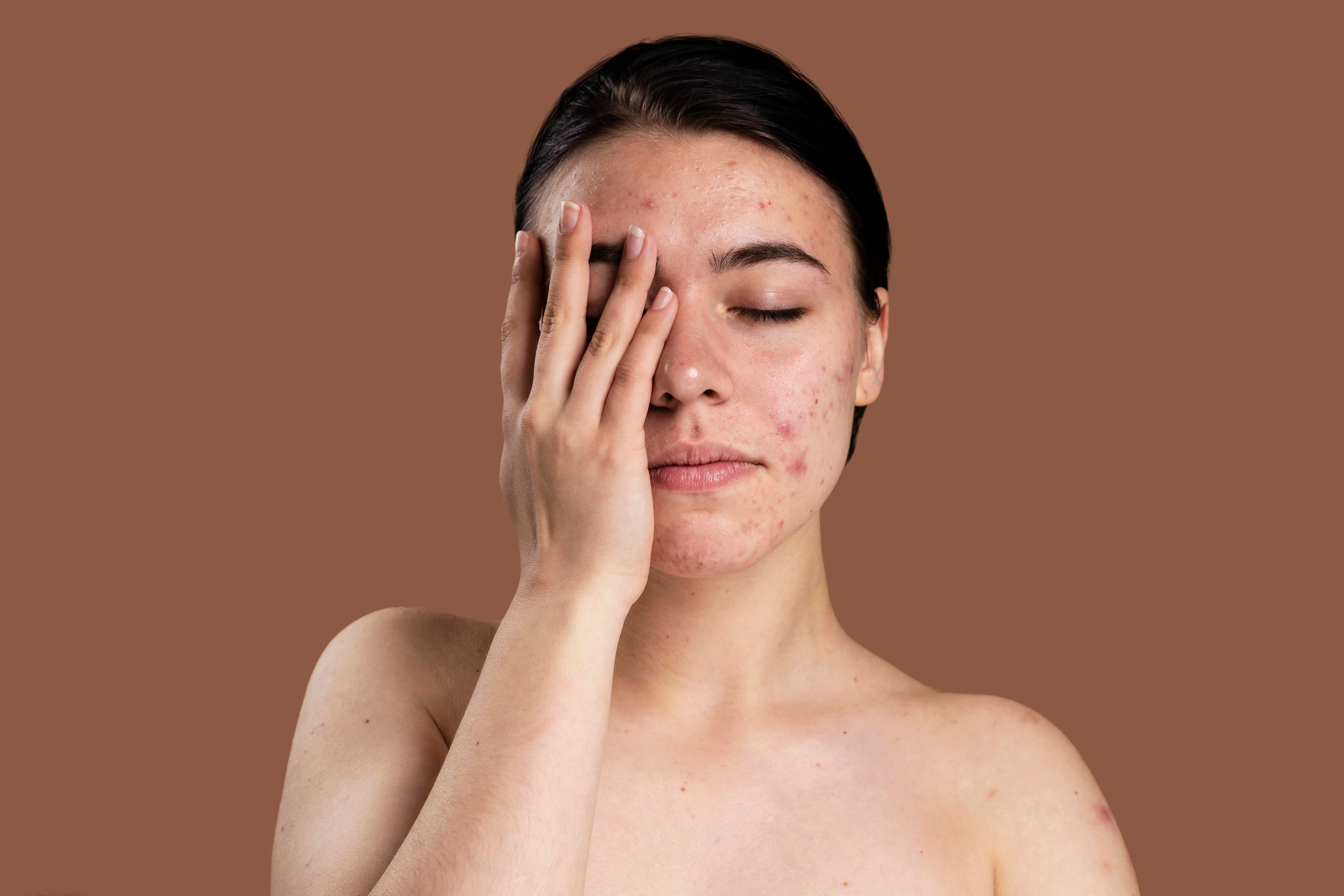 Using ice to remove acne | ice benefits for skin acne