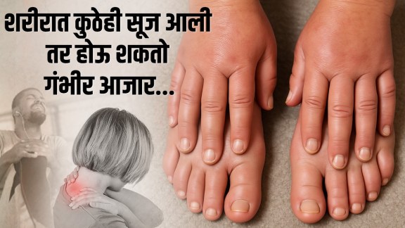Swelling in hand, legs cause Swelling in any part of body can indicate serious disease heart issues, diabetes symptoms doctor advice