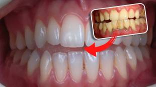 Acharya Balkrishna Reveals Ayurvedic Remedy: Jamun Bark for Strong and Shiny Teeth