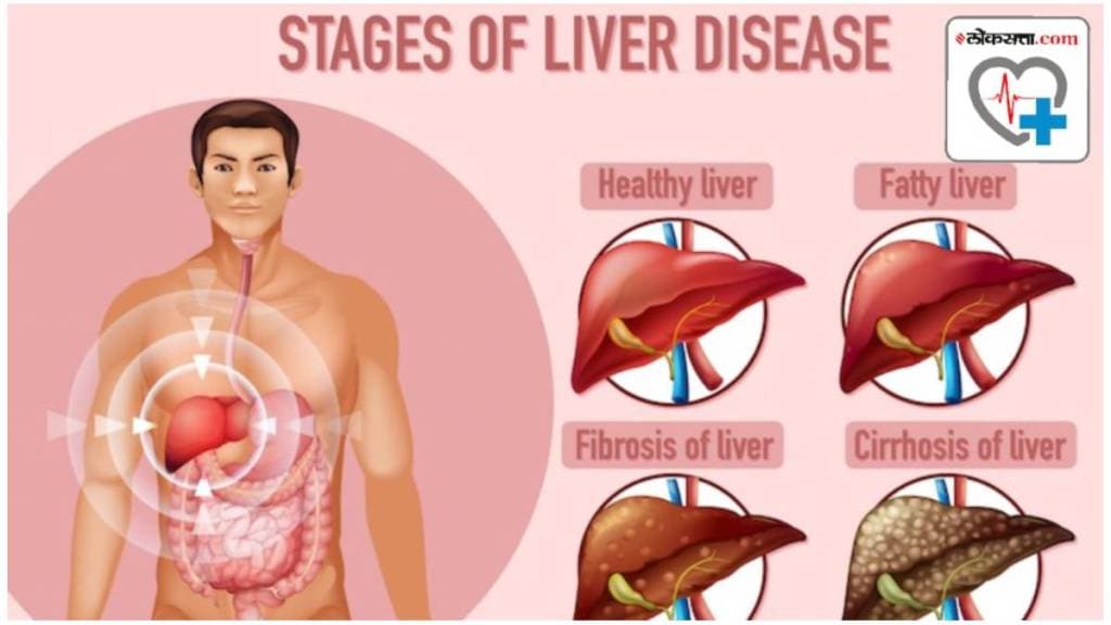 Diet For Fatty Liver Repair