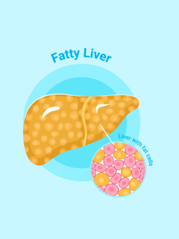 Fatty Liver Disease Symptoms