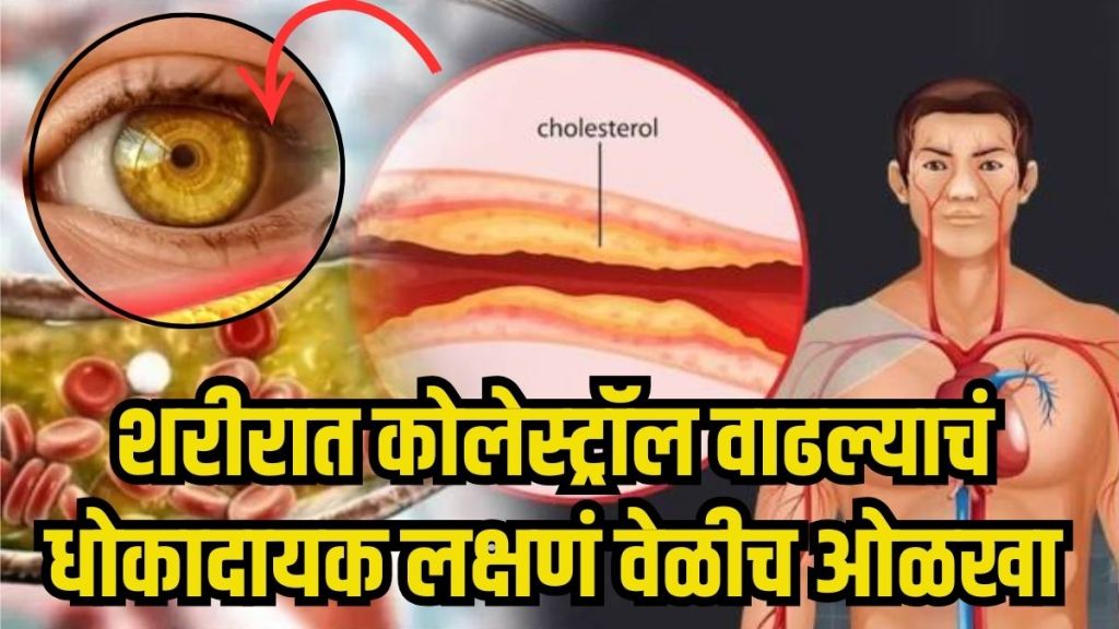 Signs of high cholesterol on body