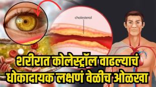 Signs of high cholesterol on body