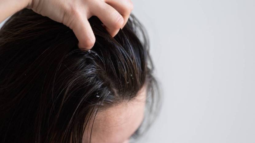 monsoon dandruff remedies