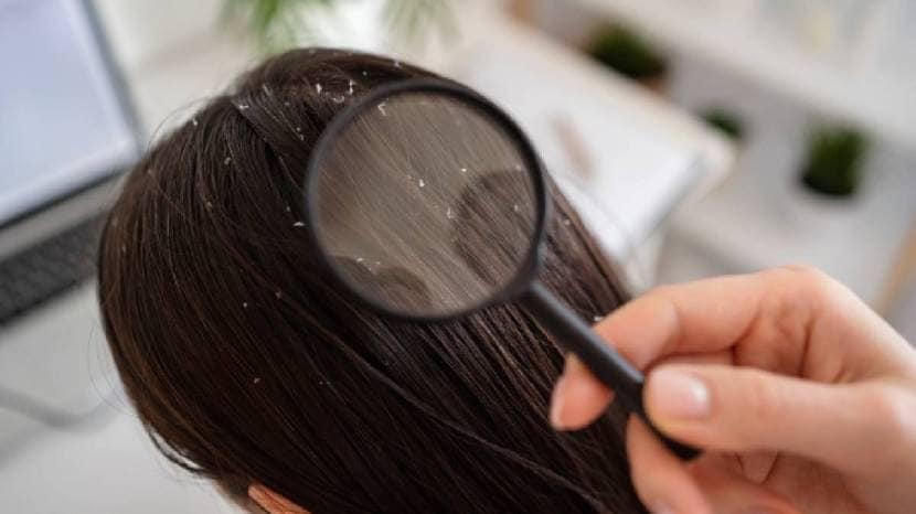 monsoon dandruff remedies