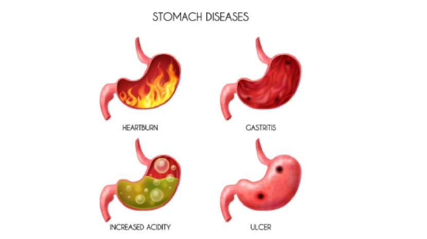 Stomach cancer symptoms