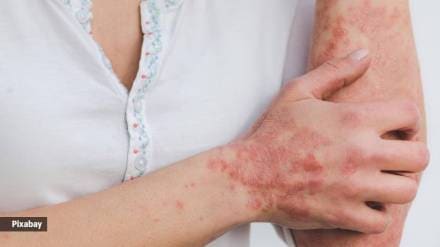 Psoriasis growing problem in India