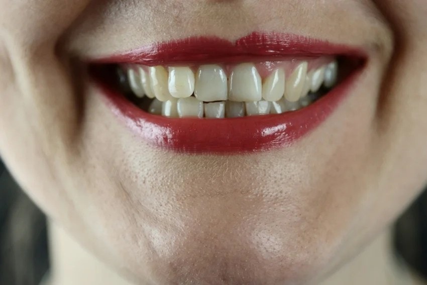 Acharya Balkrishna Reveals Ayurvedic Remedy: Jamun Bark for Strong and Shiny Teeth