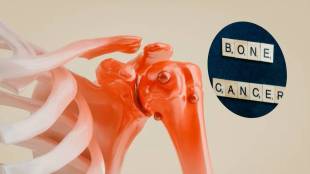bone cancer symptoms, early signs of bone cancer