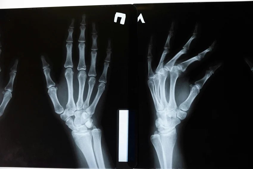bone cancer symptoms, early signs of bone cancer