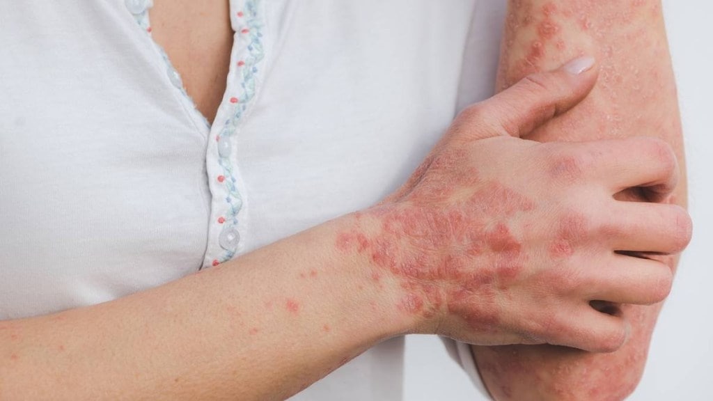 Psoriasis affects skin and joints
