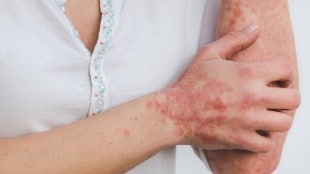 Psoriasis affects skin and joints