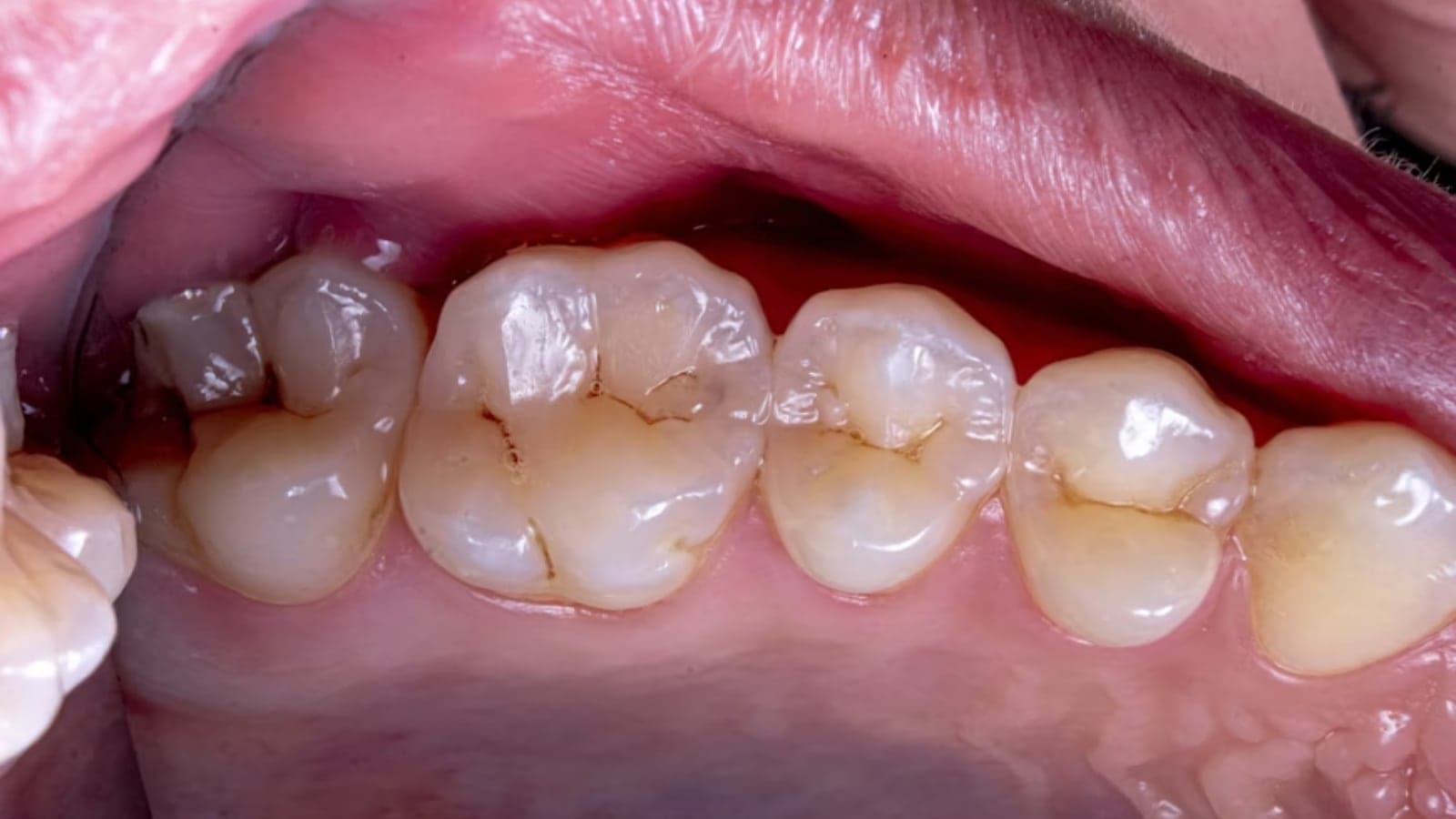 health, gums
