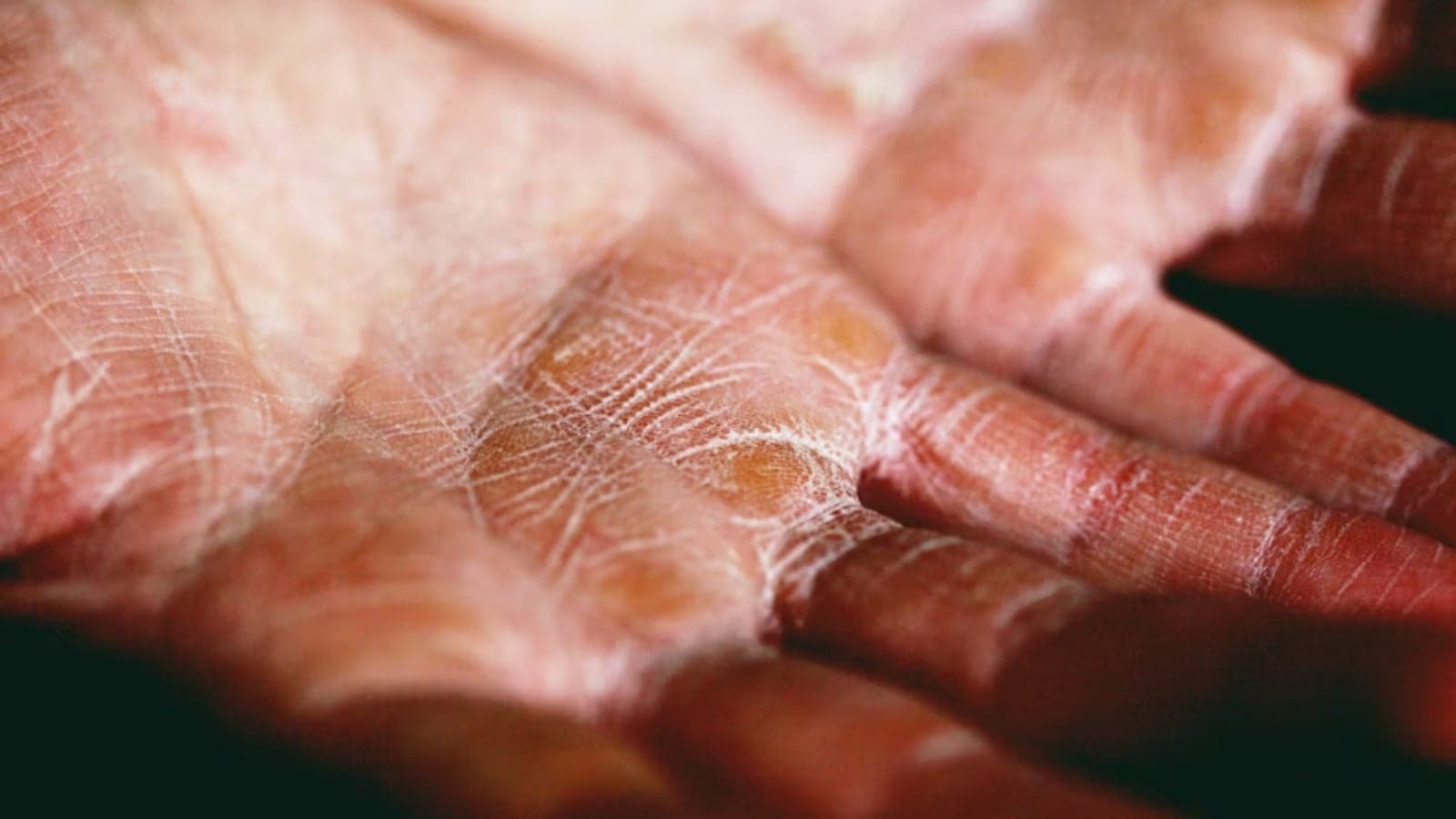 health, dry skin