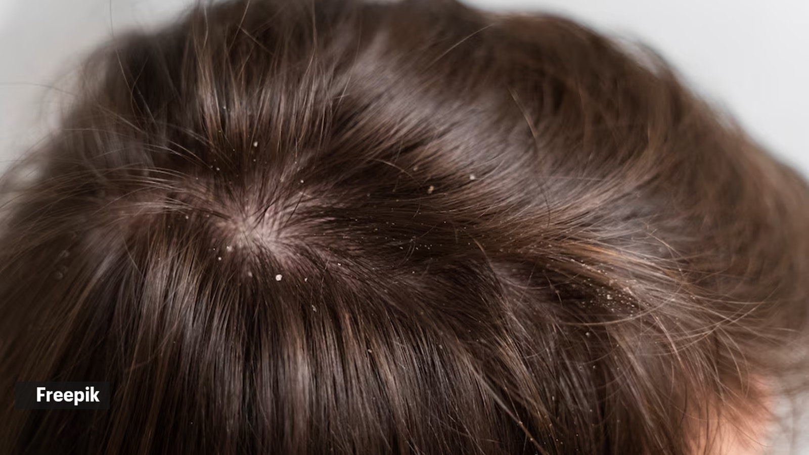 scalp
