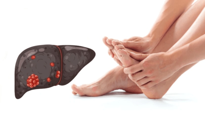 liver cancer symptoms