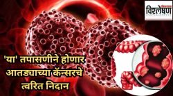 आतड्याचा कॅन्सर ओळखण्यासाठी आता AI ची मदत; त्याच्या धोक्याविषयी आरोग्यतज्ज्ञ काय सांगतात?