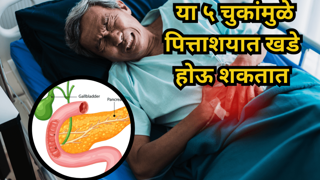 Gallstones Gallstones
