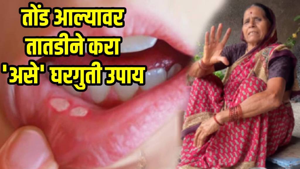 Home Remedies for Mouth Ulcers