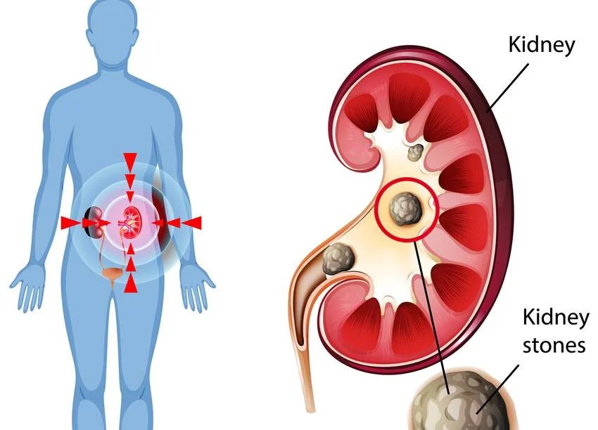 kidney stones diet 6 foods to avoid to prevent recurrence