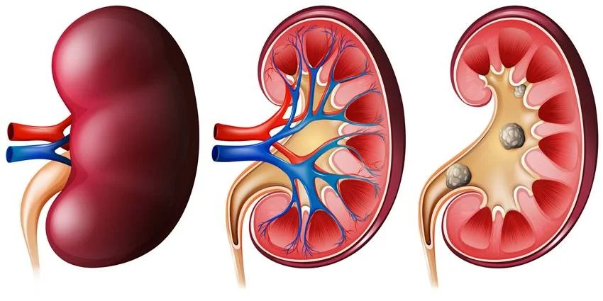 kidney stones diet 6 foods to avoid to prevent recurrence