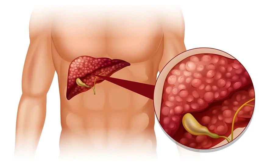 the easiest way to reduce liver fat which foods should you eat