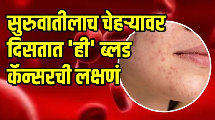 Blood Cancer Symptoms lymphoma leukemia signs symptoms and treatment blood cancer diagnosis skin cancer lakshan