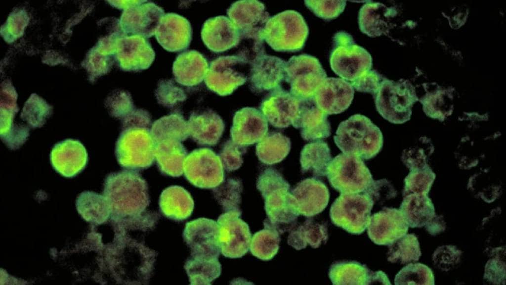 Brain-Eating Amoeba