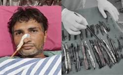 माणूस म्हणावं की कोण… त्याने २९ चमचे, १९ टूथब्रश आणि २ पेन गिळले? हा जिवंत कसा राहिला?