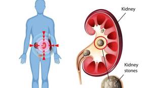 kidney stones diet 6 foods to avoid to prevent recurrence