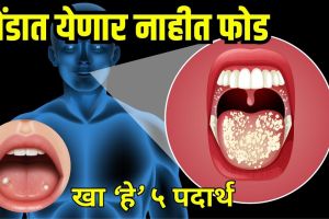 Mouth ulcer causes and remedies