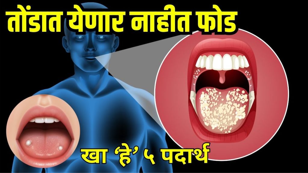 Mouth ulcer causes and remedies