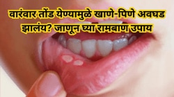 वारंवार तोंड येण्यामुळे खाणे-पिणे अवघड झालंय? जाणून घ्या रामबाण उपाय, जे देतील त्वरित आराम