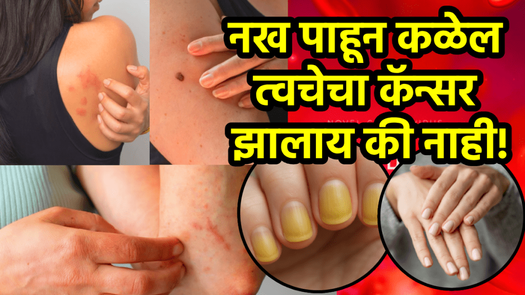Skin cancer symptoms changes in nails indicate serious disease like skin cancer lung, heart diseases, liver problems, infection how to check skin cancer