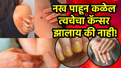 नख पाहून कळेल त्वचेचा कॅन्सर झालाय की नाही! सुरूवातीलाच दिसतात ‘ही’ लक्षणे