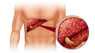 the easiest way to reduce liver fat which foods should you eat