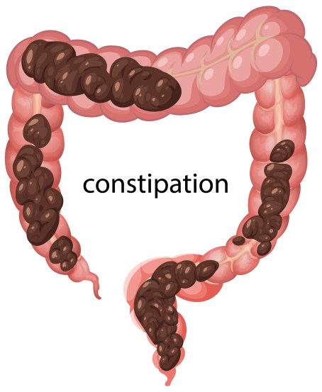 Constipation (Source : Freepik)